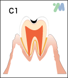 虫歯の症状