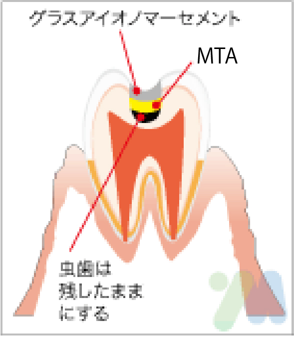 MTAセメント法での治療