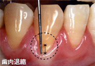 歯肉退縮