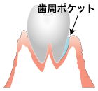 歯周ポケット