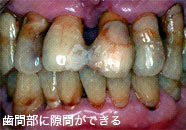 歯間部に隙間ができる